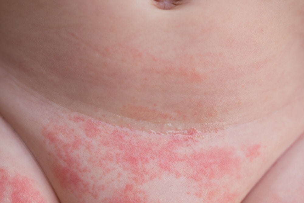 dermatitis del pañal