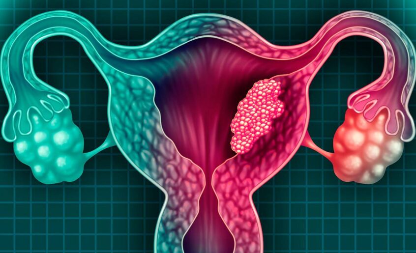 cáncer de cuello uterino