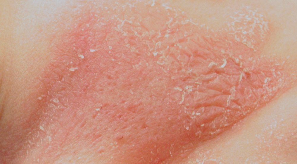 tipos de dermatitis del pañal