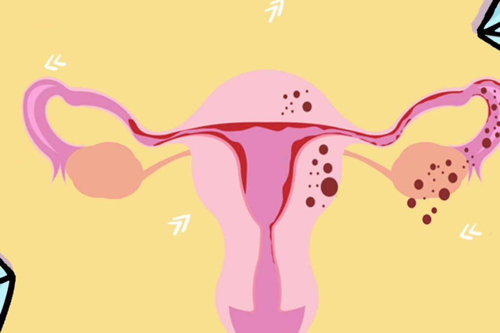 ¿qué es la endometriosis?