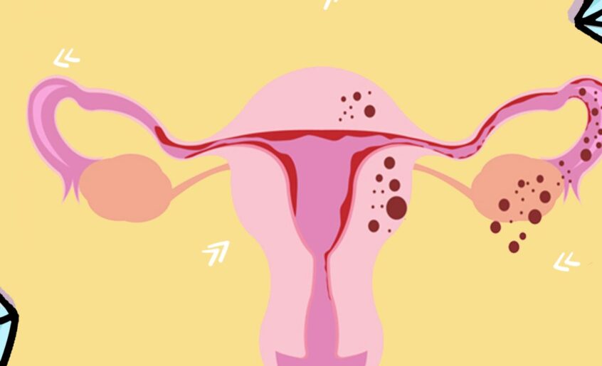 ¿qué es la endometriosis?