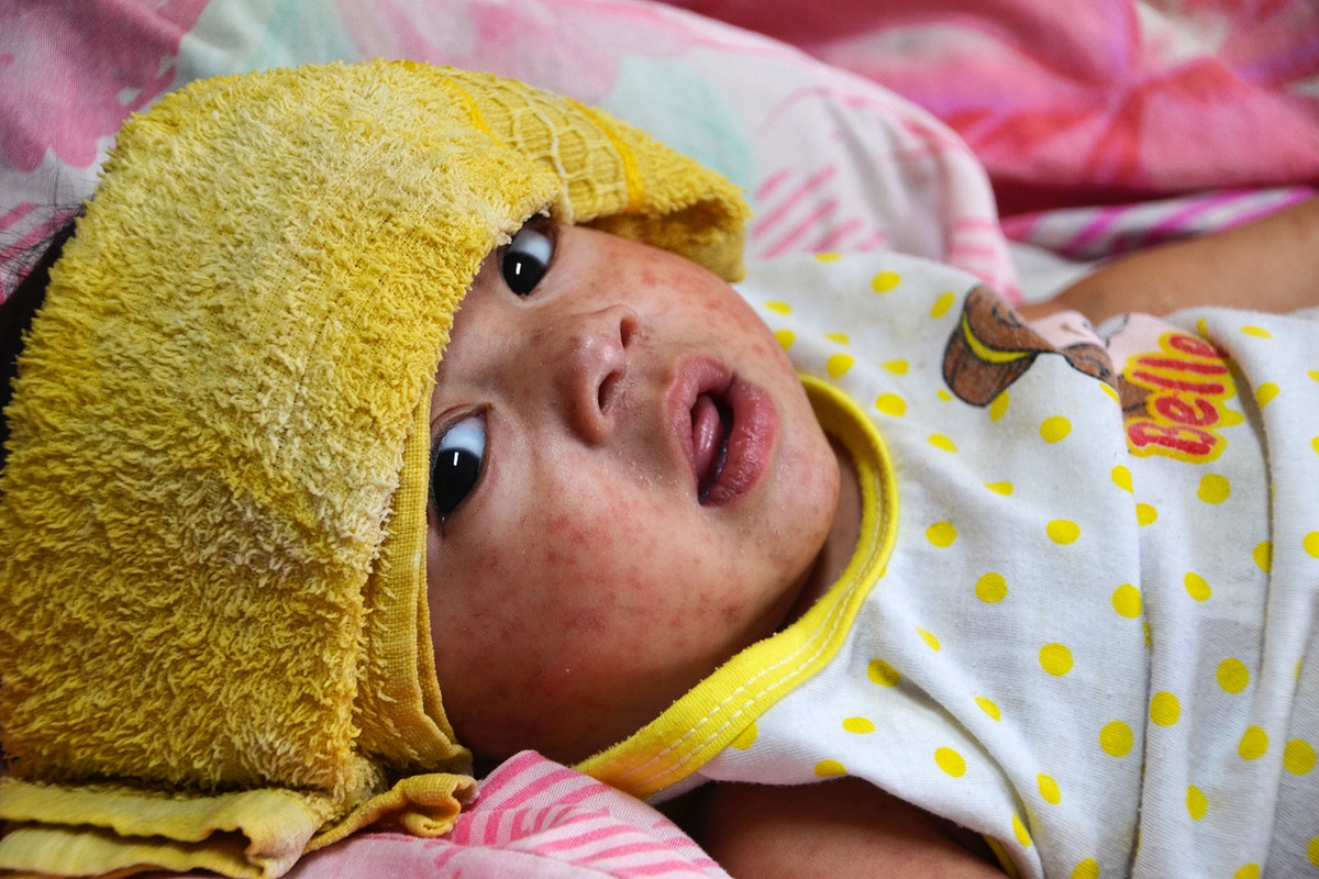 An infant in a hospital with measles (rubeola). Original image sourced from US Government department: Public Health Image Library, Centers for Disease Control and Prevention. Under US law this image is copyright free, please credit the government department whenever you can”.